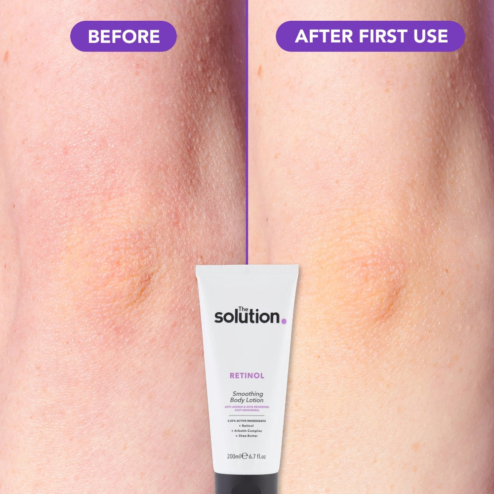 The Solution Retinol Smoothing Body Lotion before and after first use results